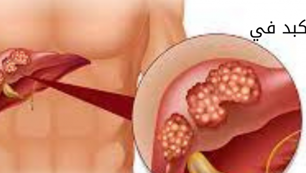 علاج سرطان الكبد في الهند